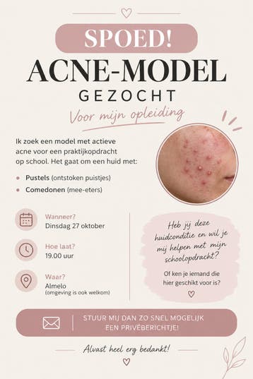 Spoed: Acne-model gezocht voor praktijkopdracht