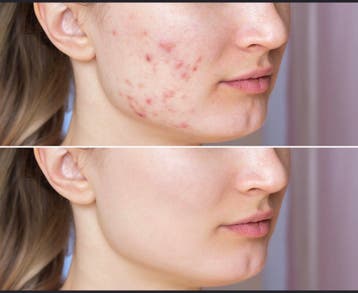 Acne model gezicht-spoed