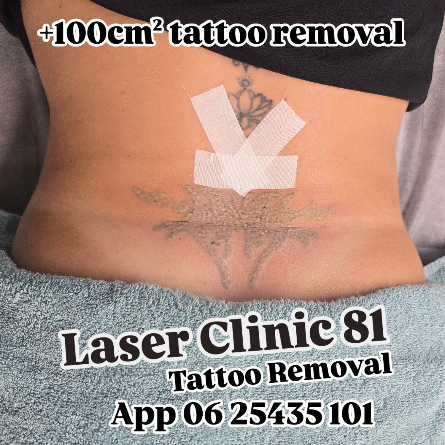Tattoo Removal v.a €37,50, Ophalen, Nieuw, Overige typen