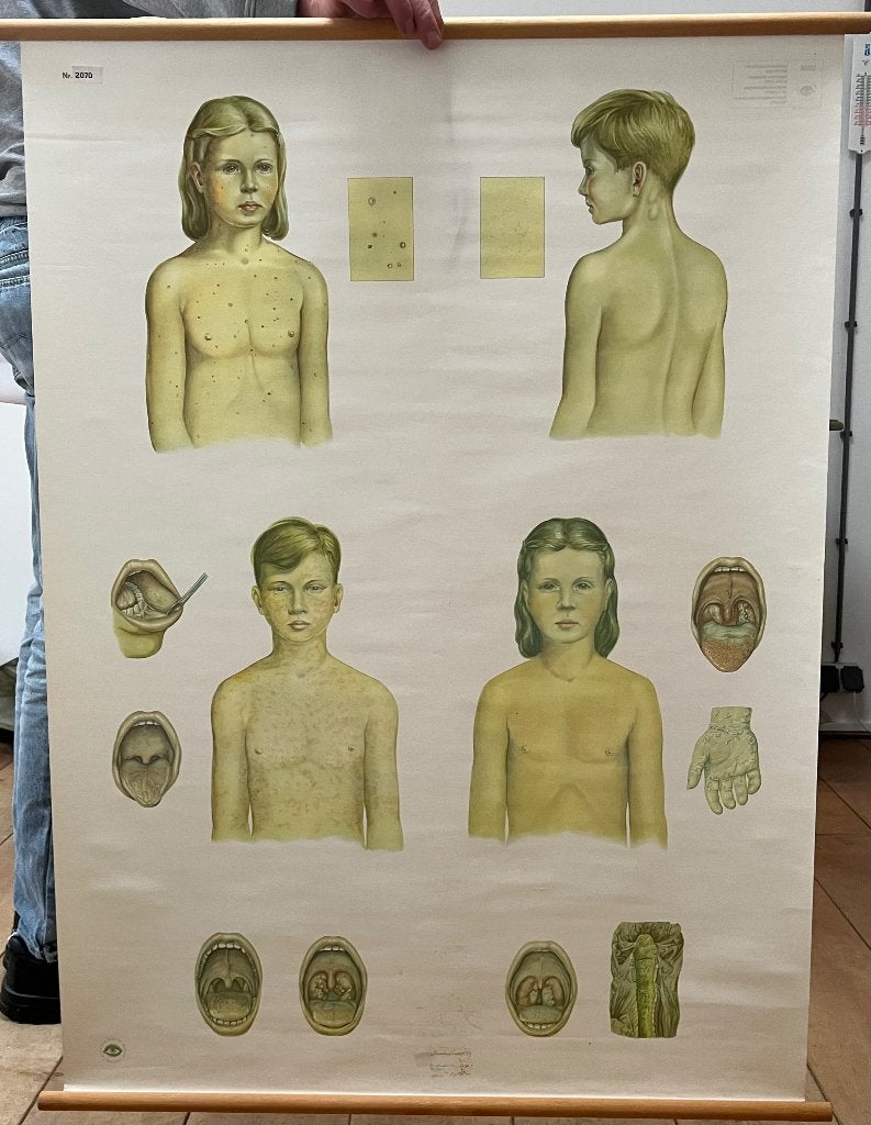 schoolplaat - kinderziekten, Antiek en Kunst, Antiek | Schoolplaten, Ophalen, Natuur en Biologie