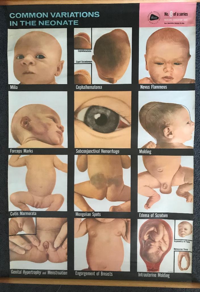 Medische schoolplaat Common variations in the neonate 1961, Antiek en Kunst, Ophalen of Verzenden, Natuur en Biologie