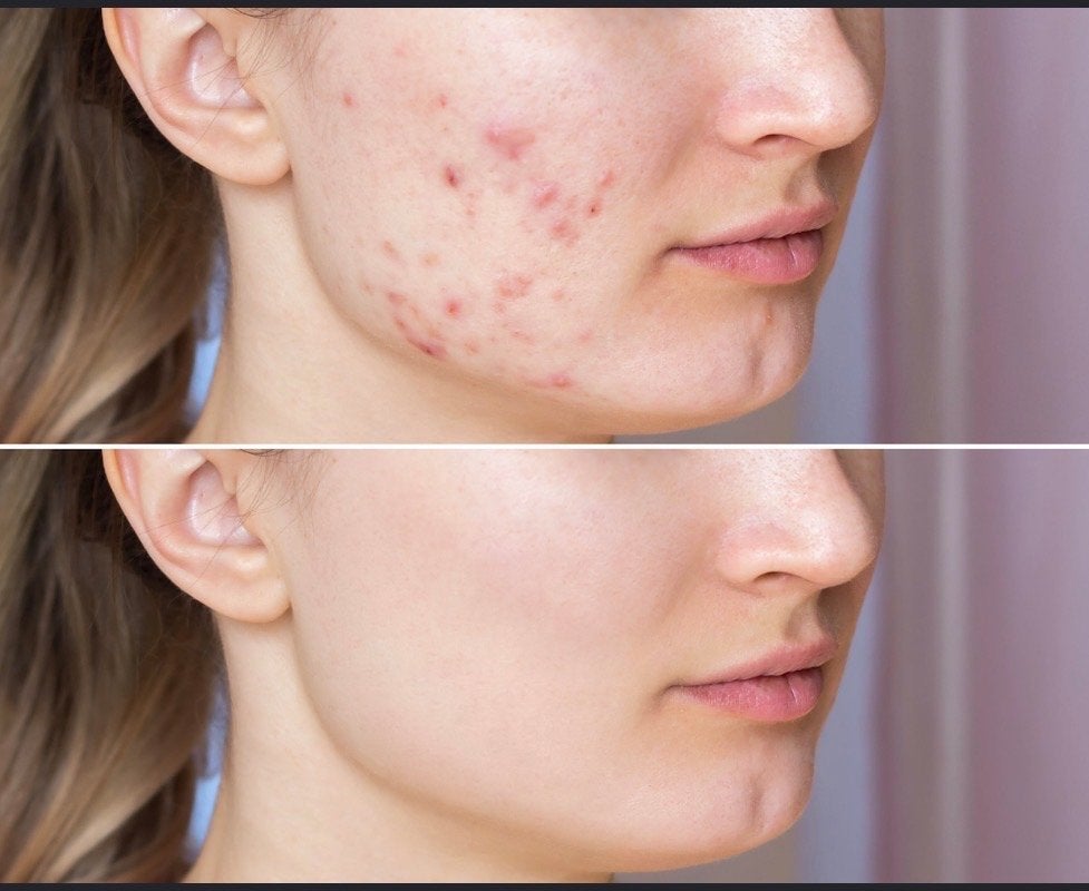 Acne model gezicht-spoed, Ophalen of Verzenden