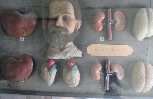 19th vitrine anatomisch wassen hoofd en organen dronkaard, Antiek en Kunst, Ophalen