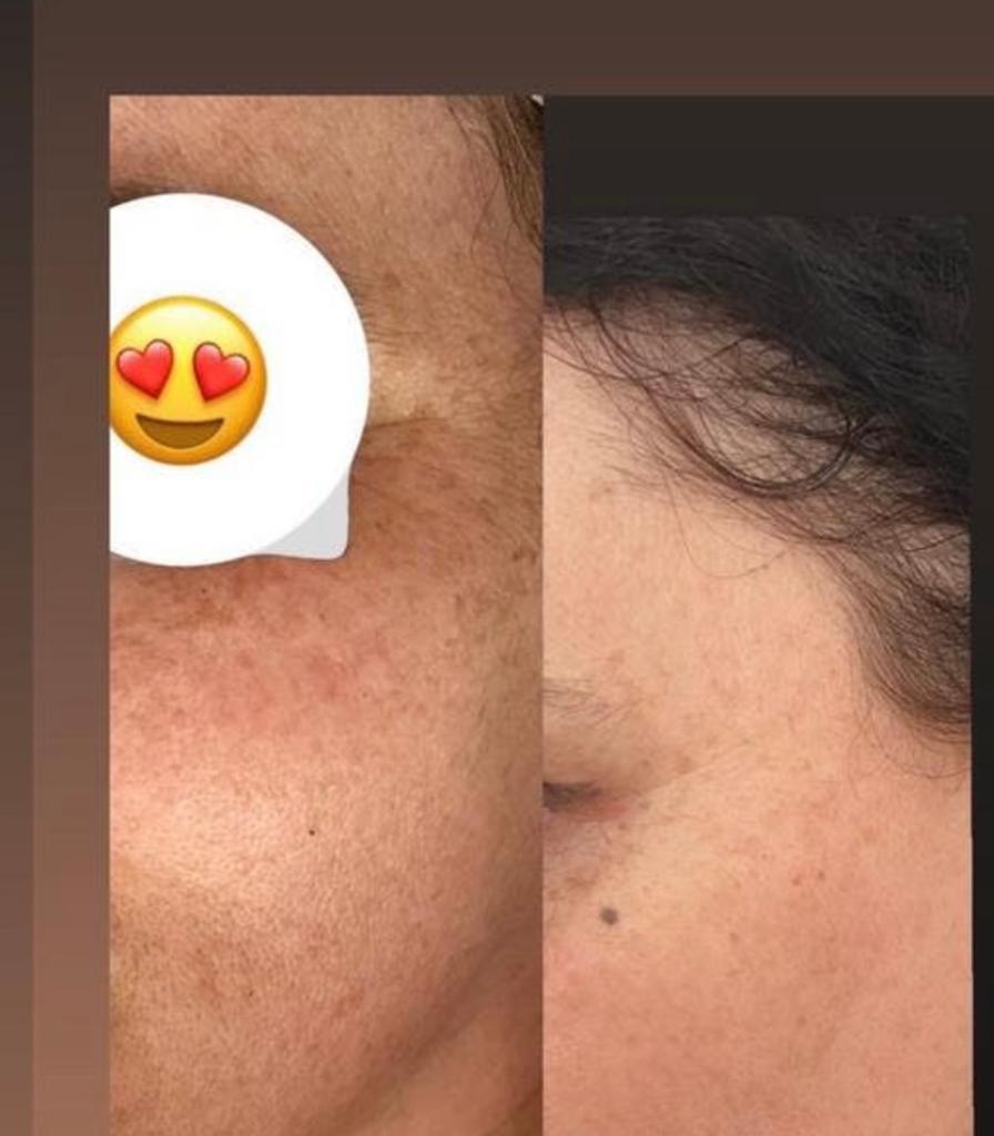 Huidverjonging aparaat co2 fraction laser, Witgoed en Apparatuur, Persoonlijke-verzorgingsapparatuur, Ophalen, Zo goed als nieuw