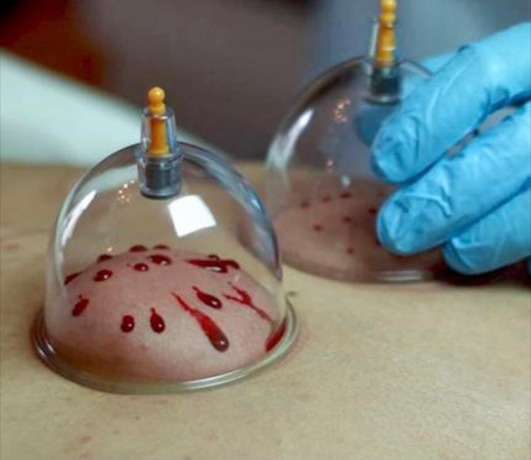 Hijama wet cupping dry cupping, Ophalen