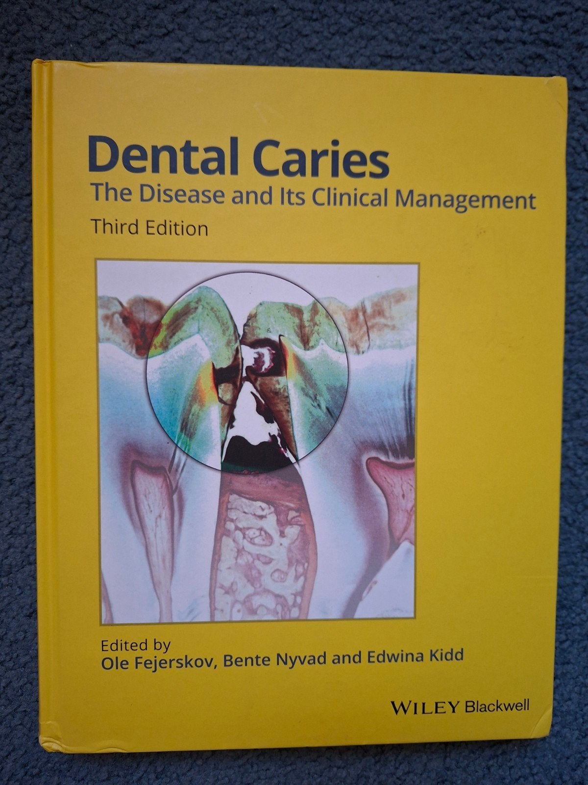 Dental Caries third edition, Boeken, Ophalen of Verzenden, Beta, Zo goed als nieuw, HBO
