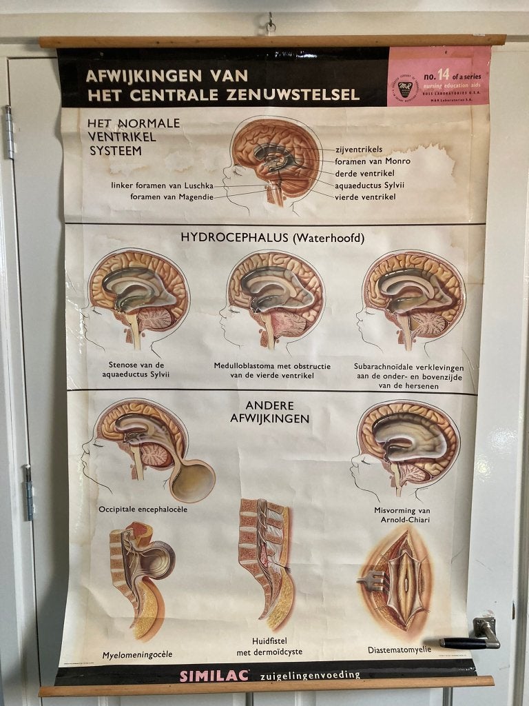Oude schoolplaat "Afwijkingen Centraal Zenuwstelsel"., Antiek en Kunst, Antiek | Schoolplaten, Ophalen of Verzenden, Natuur en Biologie