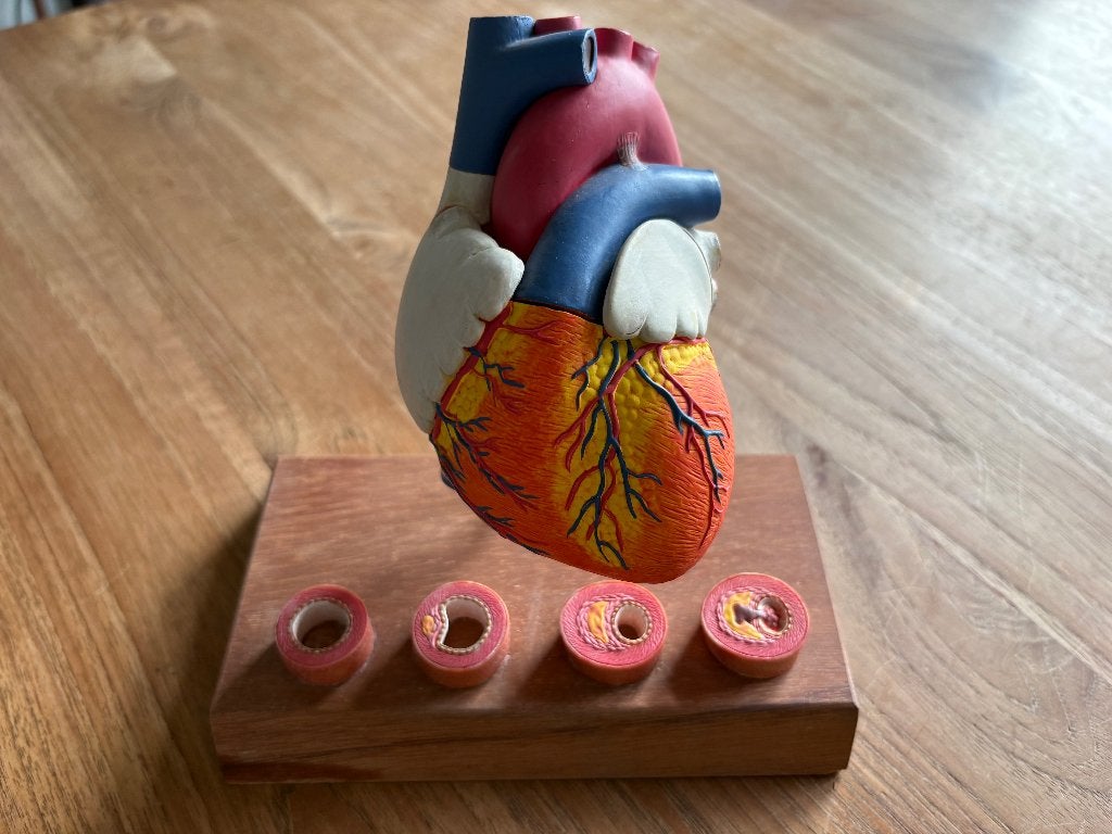 Anatomisch model van hart met vernauwde aders, Ophalen of Verzenden
