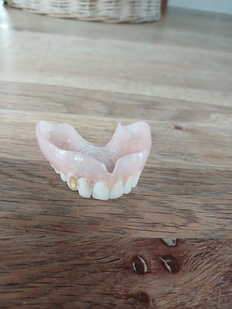 Kunstgebit boven gebit met goud stukje, Ophalen, Overige typen