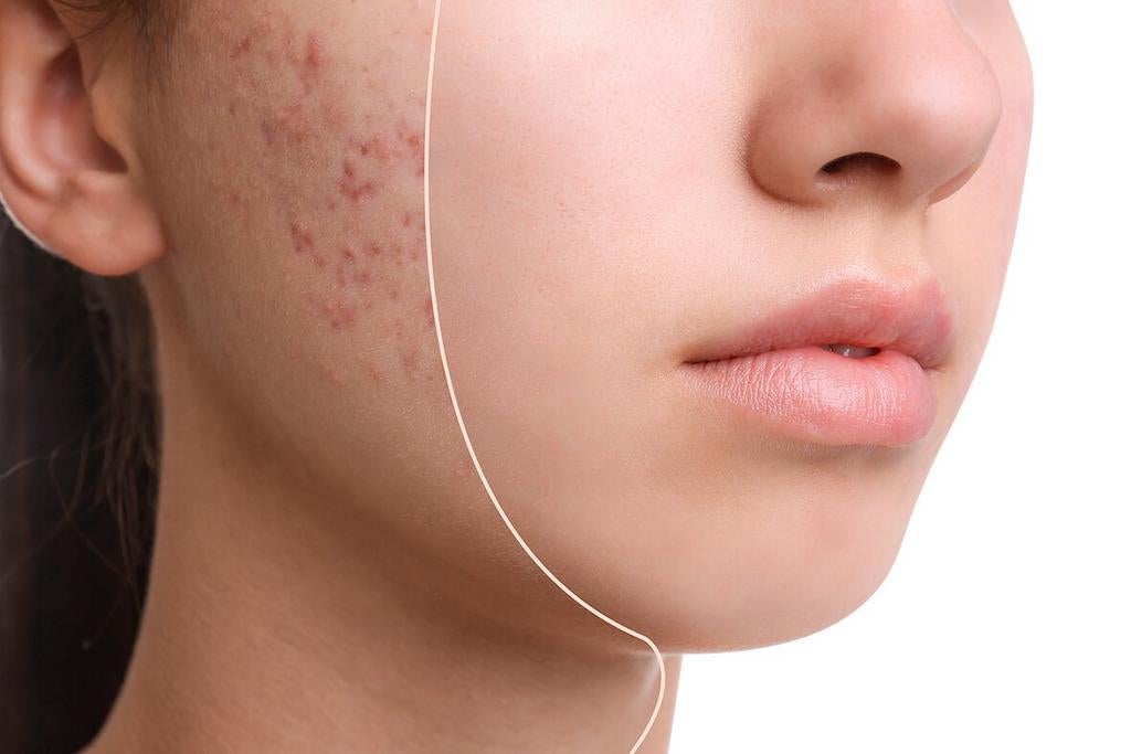 Acne gezocht, Ophalen, Nieuw