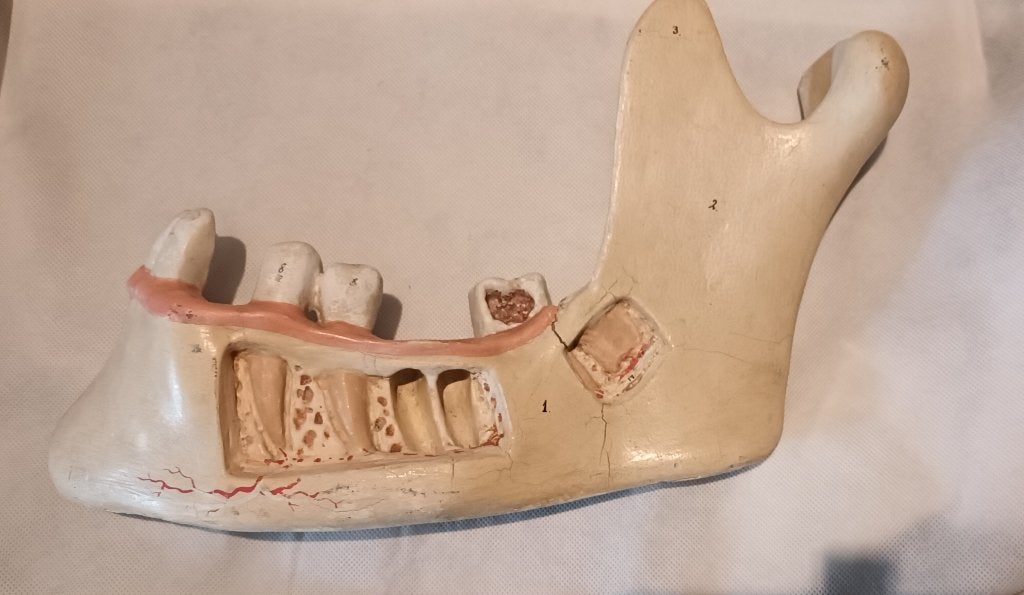 Antiek Medisch Anatomisch model van een kaak Somso, Ophalen of Verzenden