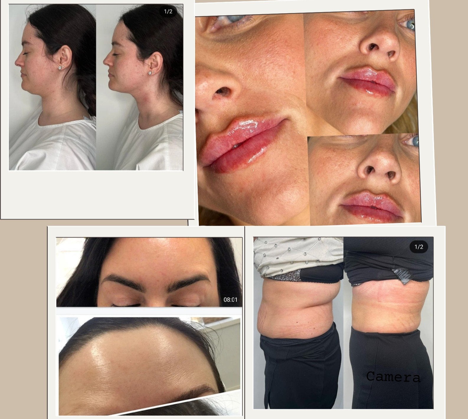 Lip fillers  V.A €90  en botoxs€60 zalm dna€80, Ophalen of Verzenden, Nieuw, Handen en Nagels