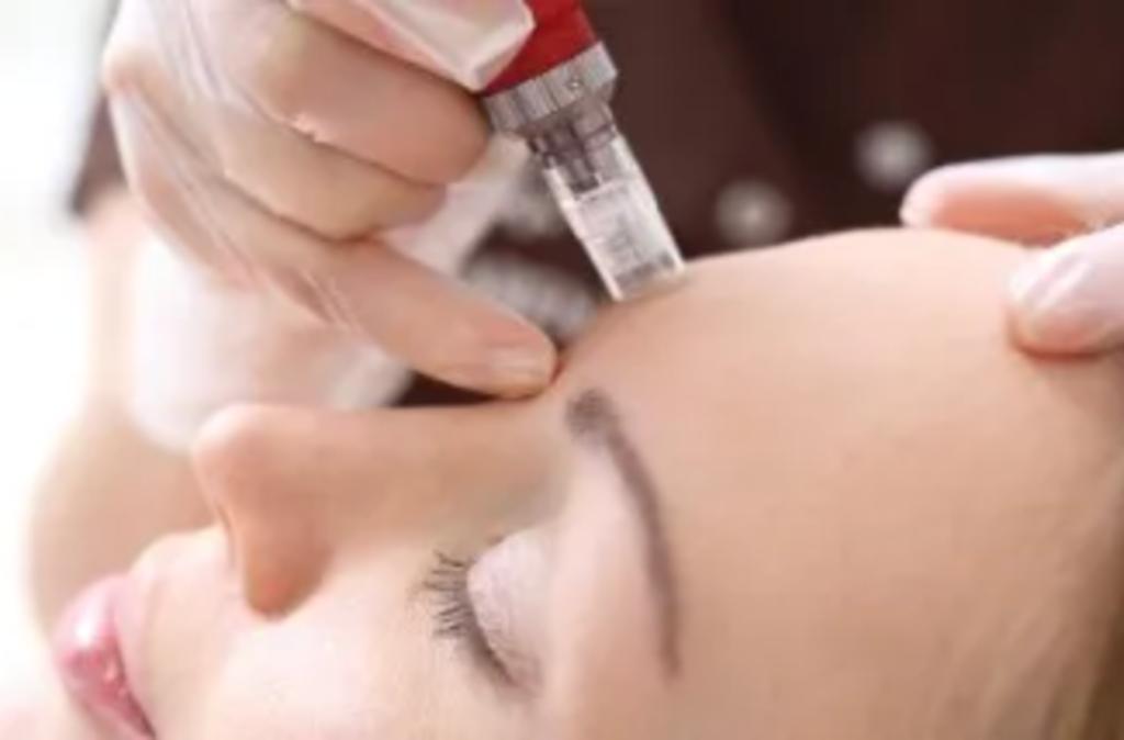 Microneedling Almere met 20% korting, Diensten en Vakmensen, Schoonheidsspecialisten | Overige, Huidbehandeling, Massage, Ontharing