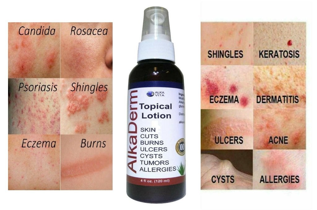 AlkaDerm Topical Spray Skin Treatment Topische Spray, Ophalen of Verzenden, Nieuw, Overige typen
