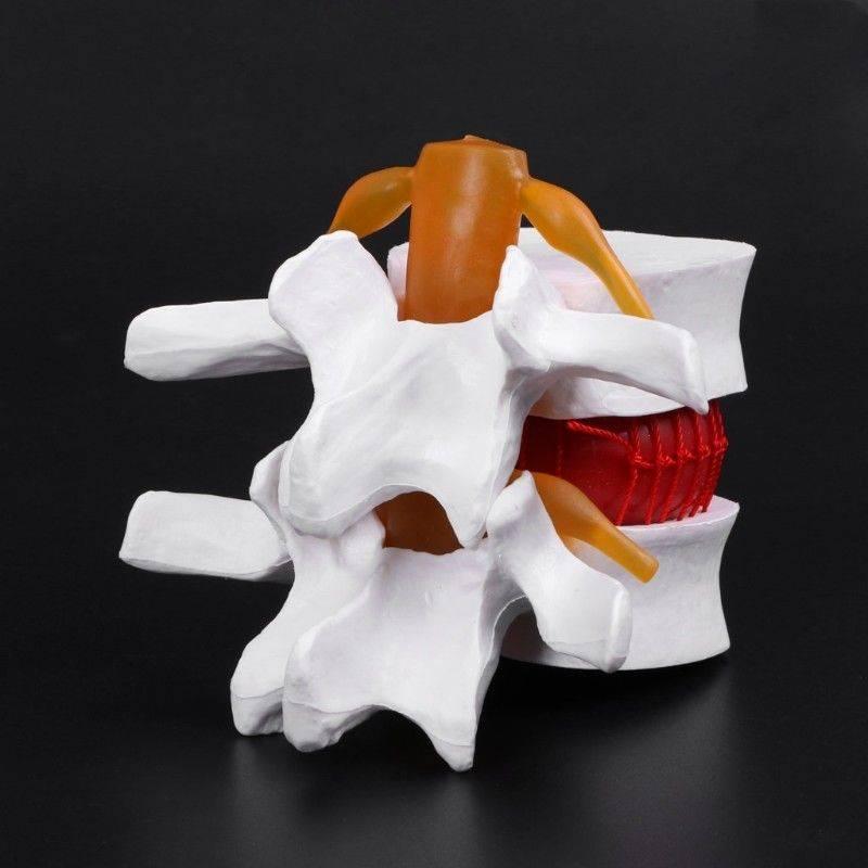 Lumbale Schijf Menselijk Anatomie Model / Hernia Medisch, Diversen, Schoolbenodigdheden, Verzenden, Nieuw