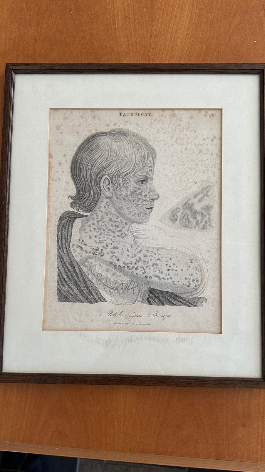 Antieke (200 jr oude) medische gravure: Rubeola vulgaris, Antiek en Kunst, Dagelijks leven, 1800 - 1899, Gravure, Met tekst