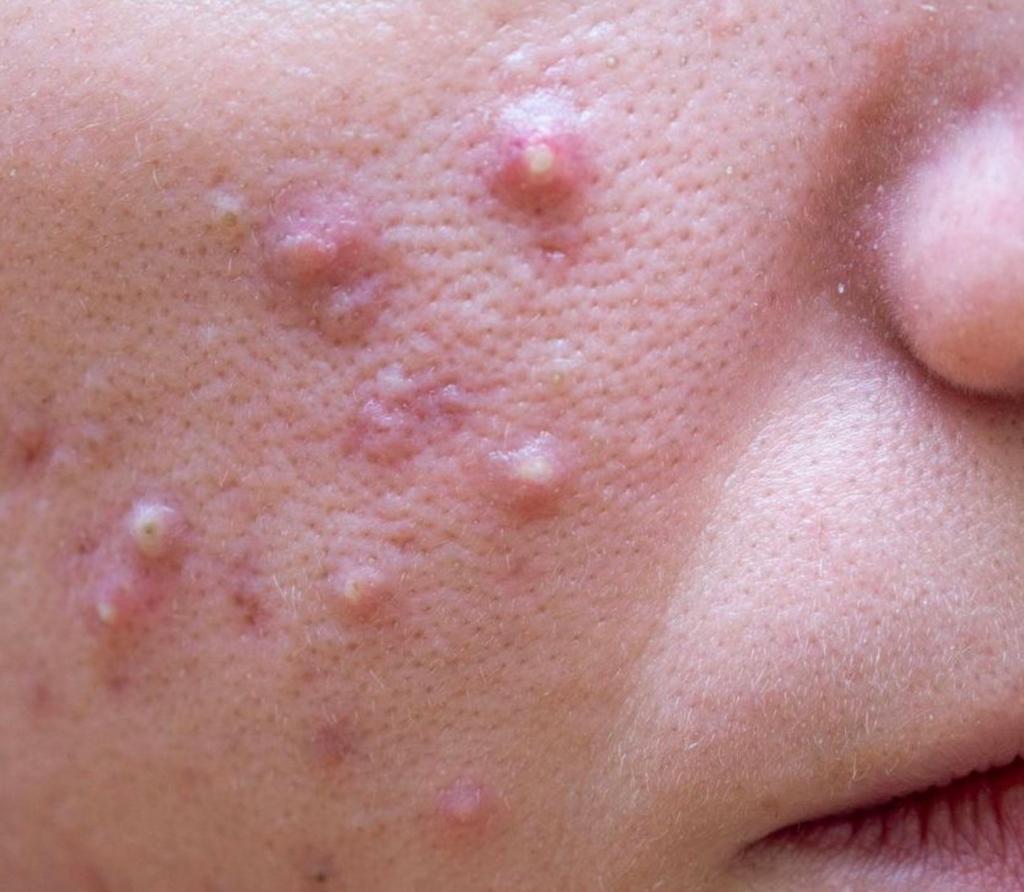 Huidverzorging voor acne en onzuiverheden, Ophalen of Verzenden, Zo goed als nieuw, Overige typen