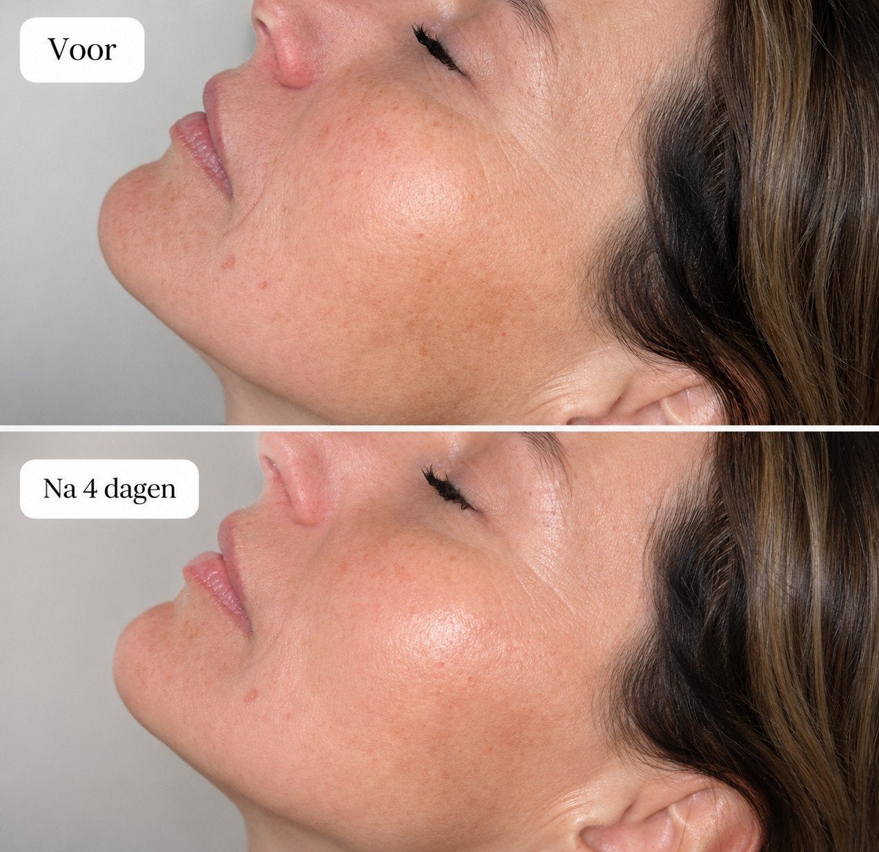 Mesotherapie skinbooster /Microneedling/Dermaplaning, Ophalen of Verzenden, Nieuw, Gehele gezicht