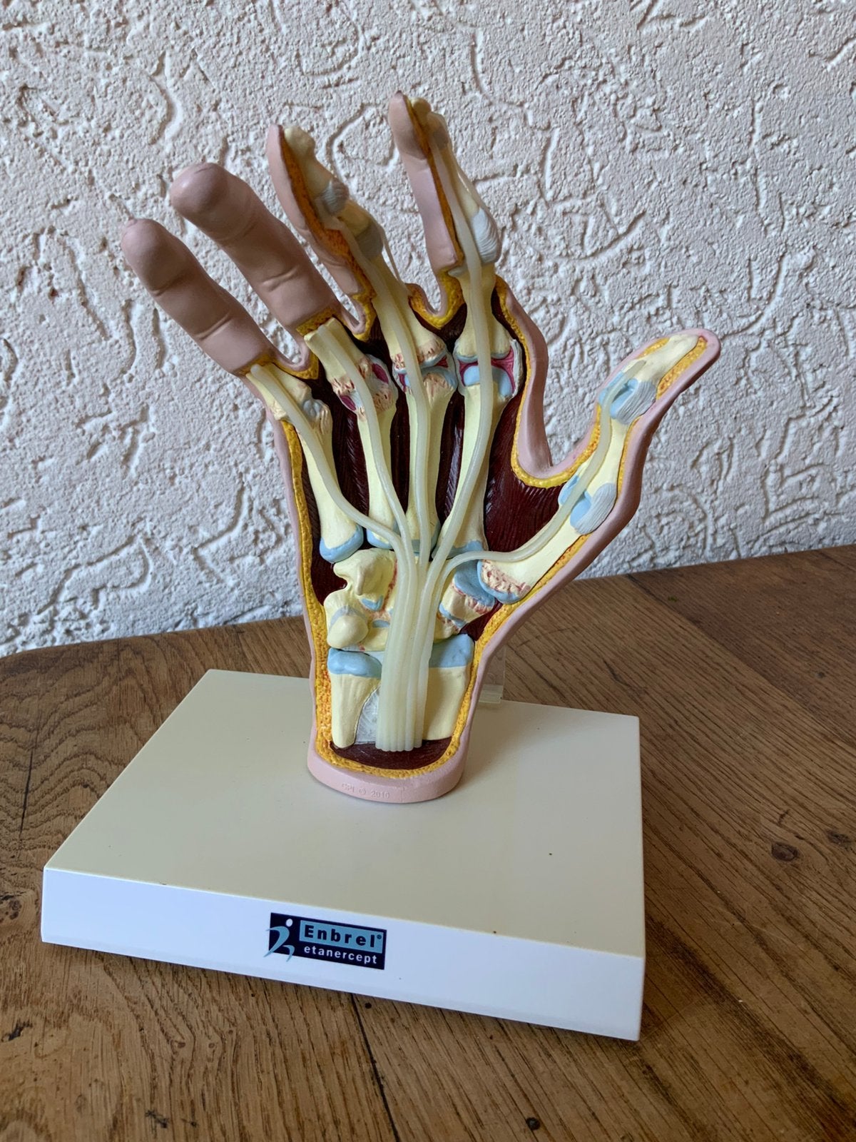 Anatomisch Model Van een Reumatische Hand, Ophalen of Verzenden