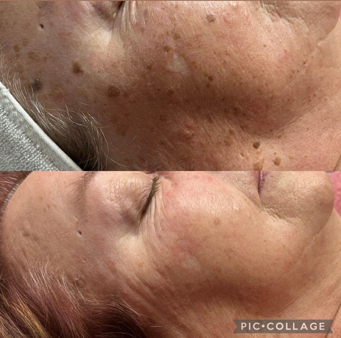 Sparkpro diode laser en ipl, Ophalen, Gebruikt