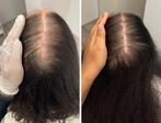 Mesotherapie haar meso haren, Nieuw, Ophalen of Verzenden