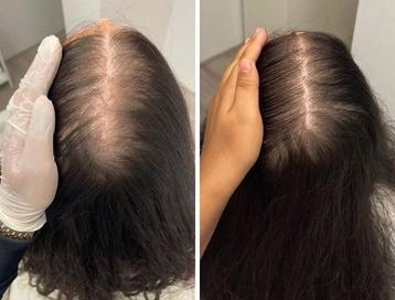 Mesotherapie haar meso haren