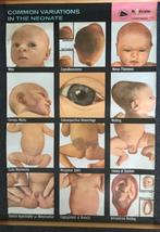 Medische schoolplaat Common variations in the neonate 1961, Ophalen of Verzenden, Natuur en Biologie