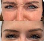 Lip filler botoxs en skin boosters, Sieraden, Tassen en Uiterlijk, Uiterlijk | Gezichtsverzorging, Ophalen of Verzenden, Nieuw