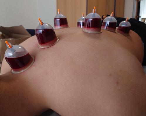 Hjjama/Wet Cupping, Cupping Massage & Dry Cupping, Diensten en Vakmensen, Welzijn | Masseurs en Massagesalons, Overige massages