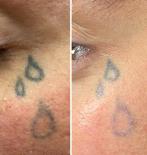 Gratis - modellen gezocht voor tattoo removal, Sieraden, Tassen en Uiterlijk, Uiterlijk | Gezichtsverzorging, Ophalen, Nieuw, Gehele gezicht