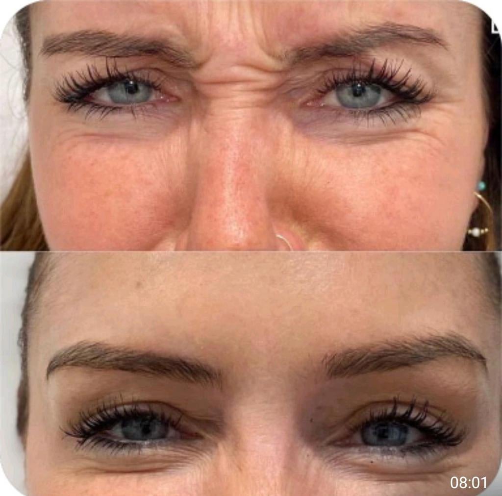 Anti rimpel  behandelingen lip vergroting, Ophalen of Verzenden, Zo goed als nieuw, Lippen