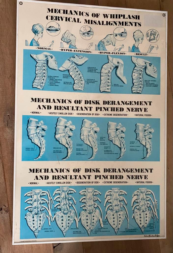 Oude medische poster anatomie chiropractor whiplash, Verzamelen, Posters, Gebruikt, Overige onderwerpen, A1 t/m A3, Rechthoekig Staand
