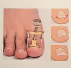 CORRECTOR of CLIP, BRACE voor INGROEIENDE TEENNAGELS, Ophalen of Verzenden, Nieuw