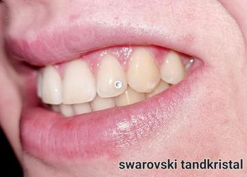 toothgem,  tandkristal, tandversiering 