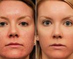 Pico laser Carbon Peeling, Nieuw, Gehele gezicht, Verzorging, Ophalen