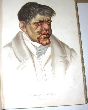 Les Maladies de la Peau 1856 Cazenave Dermatologie 60 platen beschikbaar voor biedingen