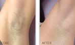 Permanent  laser ontharing diode ice en tanden bleken, Ontharing