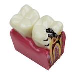 Kies Menselijk Anatomie Model School Tanden Caries Tandarts, Diversen, Verzenden, Nieuw