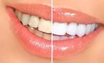 Tanden bleken met Opalescence bleekgel!, Sieraden, Tassen en Uiterlijk, Nieuw, Ophalen of Verzenden