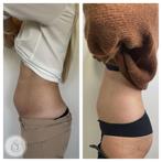 Cryolipolyse (vet bevriezen) afslanken, Ophalen of Verzenden, Zo goed als nieuw