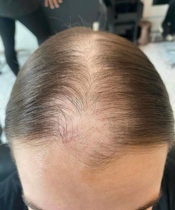 Meso therapie beschikbaar voor biedingen