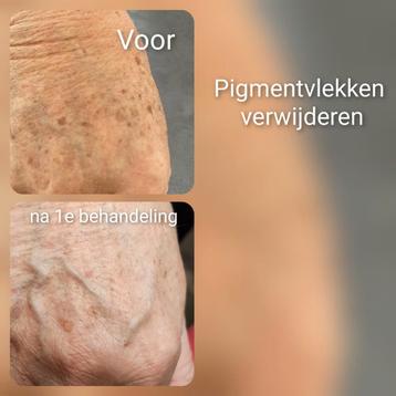 Tatoeage verwijderen beschikbaar voor biedingen