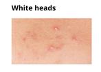 Acne model gezocht, Diensten en Vakmensen, Schoonheidsspecialisten | Overige, Huidbehandeling
