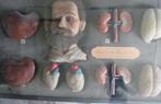 19th vitrine anatomisch wassen hoofd en organen dronkaard, Antiek en Kunst, Ophalen