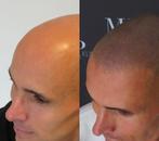 Oproep – Scalp Microhair Pigmentation (pilottraject), Ophalen, Zo goed als nieuw