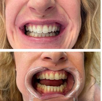 Tandenbleken,🎃💥TIJDELIJKE HERFST ACTIE💥125 EURO💥 beschikbaar voor biedingen