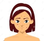 Model met acne – zaterdag 29 november-gratis behandeling, Ophalen of Verzenden, Nieuw, Gehele gezicht, Reiniging