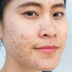 ACNE MODEL GEZOCHT, Sieraden, Tassen en Uiterlijk, Uiterlijk | Gezichtsverzorging, Nieuw, Gehele gezicht, Ophalen of Verzenden