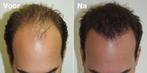 Haargroei behandeling, Sieraden, Tassen en Uiterlijk, Uiterlijk | Haarverzorging, Ophalen of Verzenden, Nieuw, Haarverzorger of -hersteller