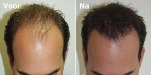 Haargroei behandeling, Sieraden, Tassen en Uiterlijk, Uiterlijk | Haarverzorging, Nieuw, Haarverzorger of -hersteller, Ophalen of Verzenden
